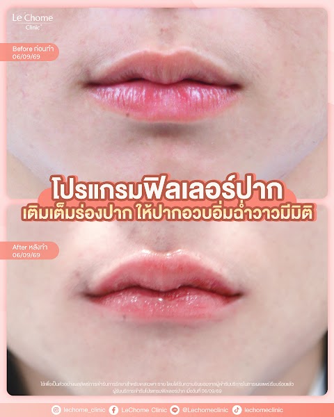 รีวิวฟิลเลอร์ — ฟิลเลอร์