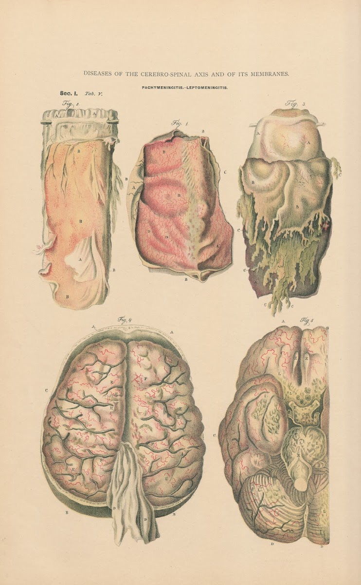 Acute Haemorrhagic Pachy Meningitis And Lepto Menipgitis 1888