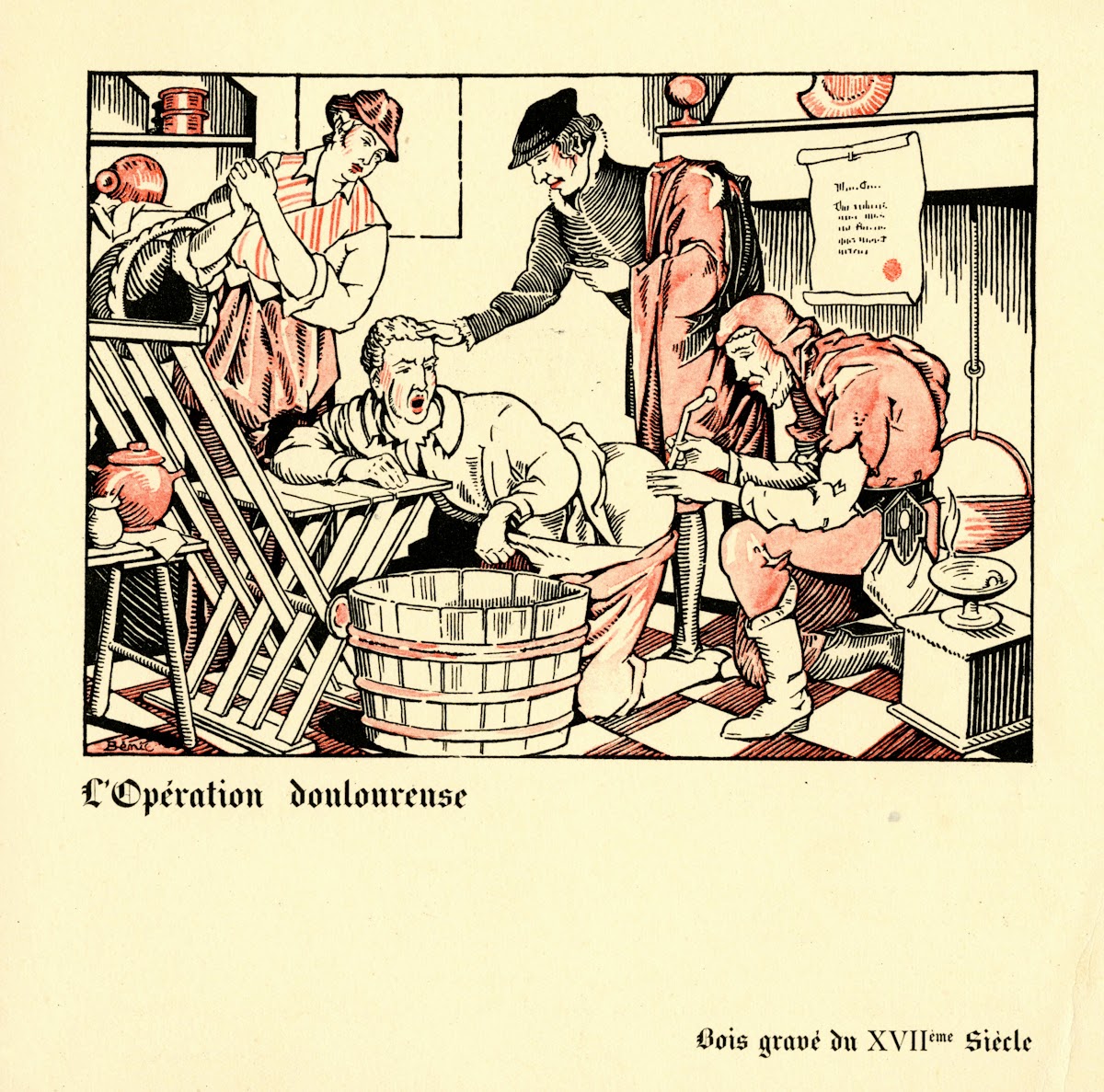 LopéRation Douloureuse