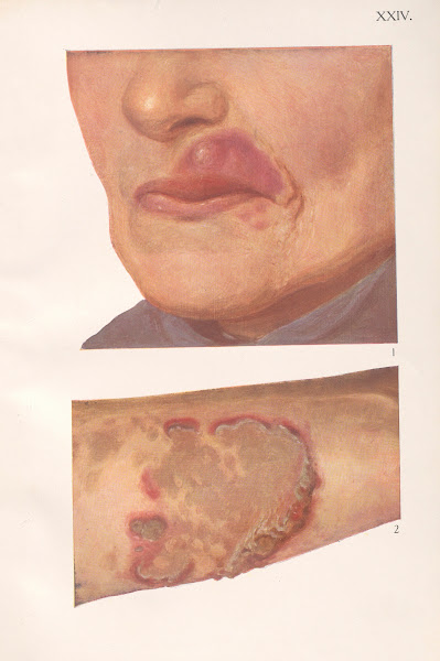 Venereal diseases  Syphilis Pl24 1908