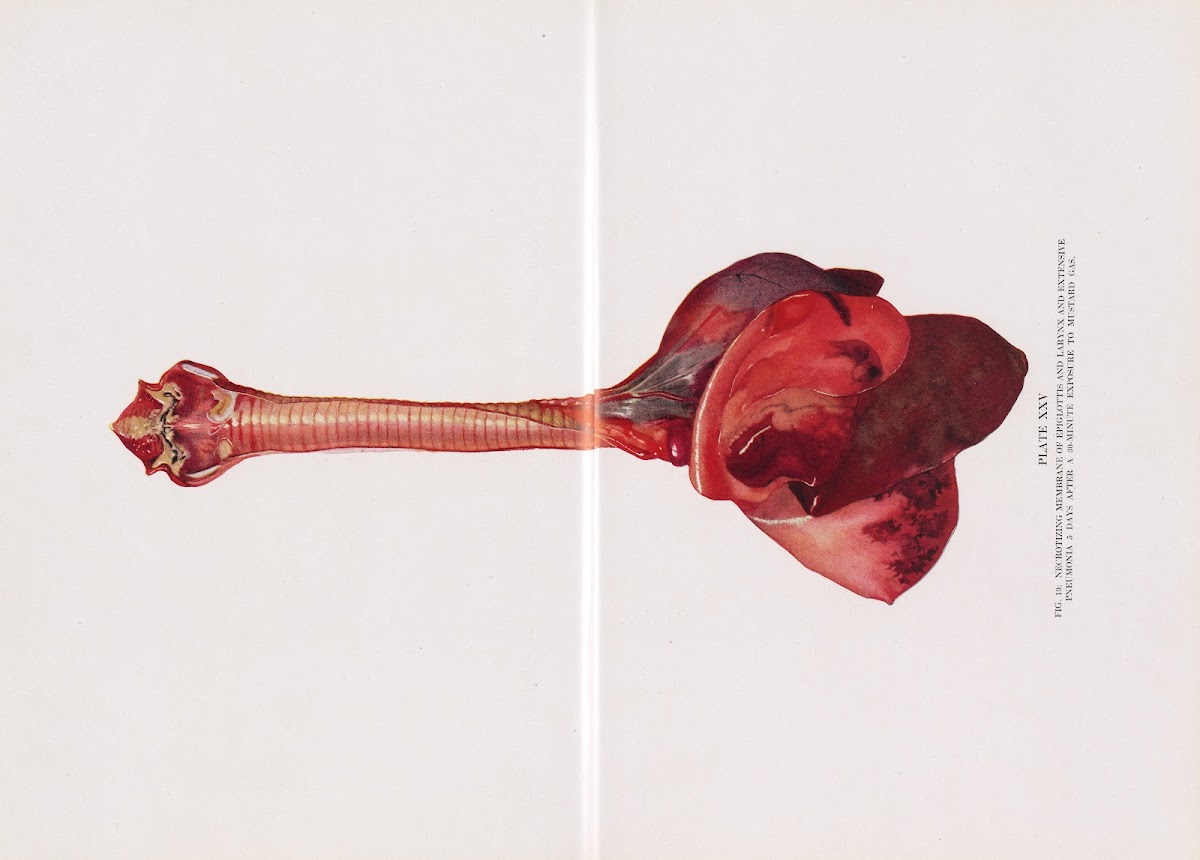 Plate XXV Fig 19 Necrotizing membrane of epiglottis and larynx and extensive pne