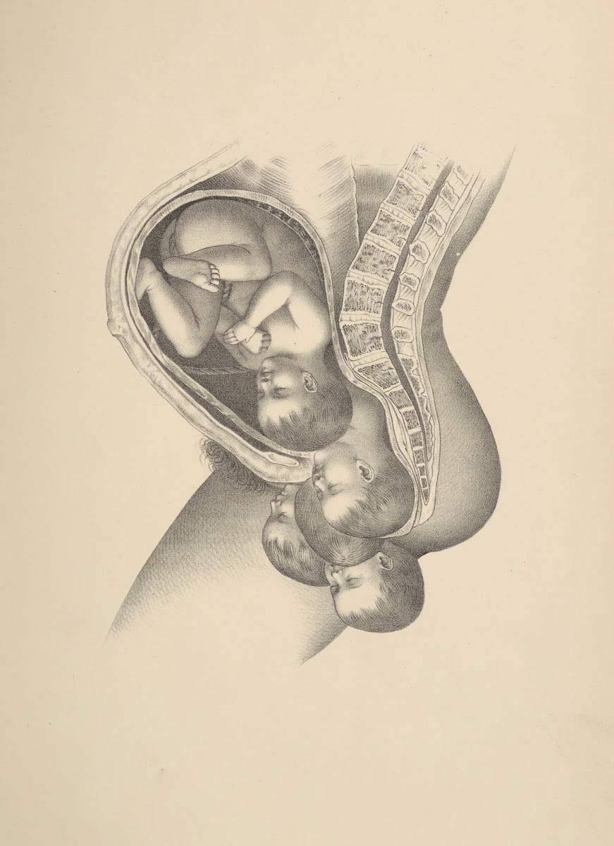 Fronto anterior Termination of the Third Position 1885