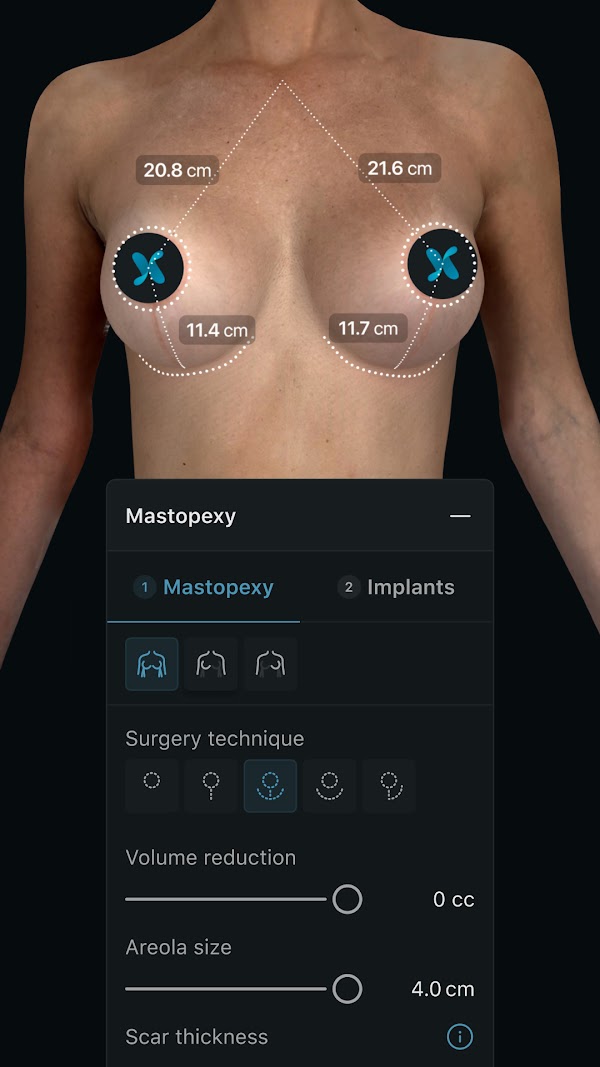 Simulation mammaire 3D dans l’application Crisalix avec l’outil de procédure « Mastopexy » ouvert. 1080px x 1920px.