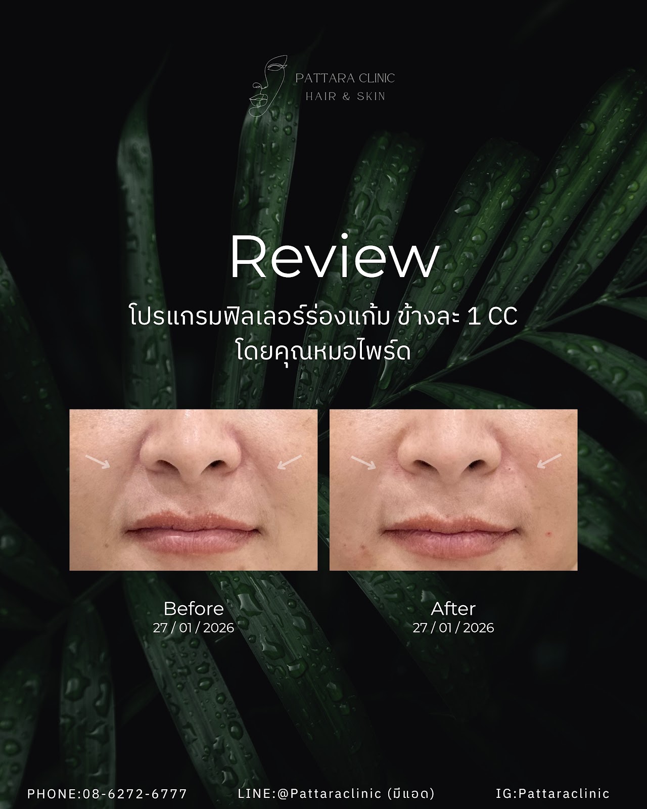 รีวิวฟิลเลอร์ร่องแก้ม เคสที่ 2