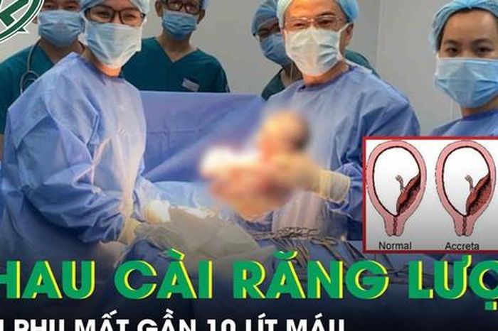 Thai phụ 36 tuần mất gần 10 lít máu, nguy hiểm tính mạng vì tai biến nhau cài răng lược - Báo Sức Khỏe &amp; Đời Sống