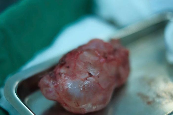 Bé 10 ngày tuổi thoát khỏi u quái hiếm gặp gây nguy hiểm tính mạng - Báo Tri thức &amp; Cuộc sống