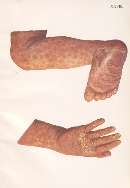 Venereal diseases  Syphilis Pl28 1908