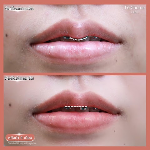 ตกแต่งริมฝีปาก