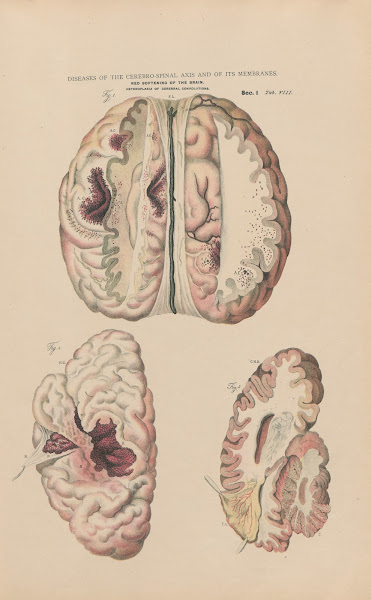 Softening Of The Brain Inflammation Of Longitudinal Sinus 1888