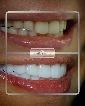 top dentist Lebanon Hollywood smile veneers implants before after Ferrari Dental Jounieh