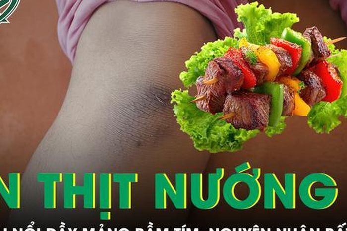 Bé trai nổi đầy mảng bầm tím sau bữa ăn thịt nướng, bác sĩ phát hiện nguyên nhân bất ngờ - Báo Sức Khỏe &amp; Đời Sống