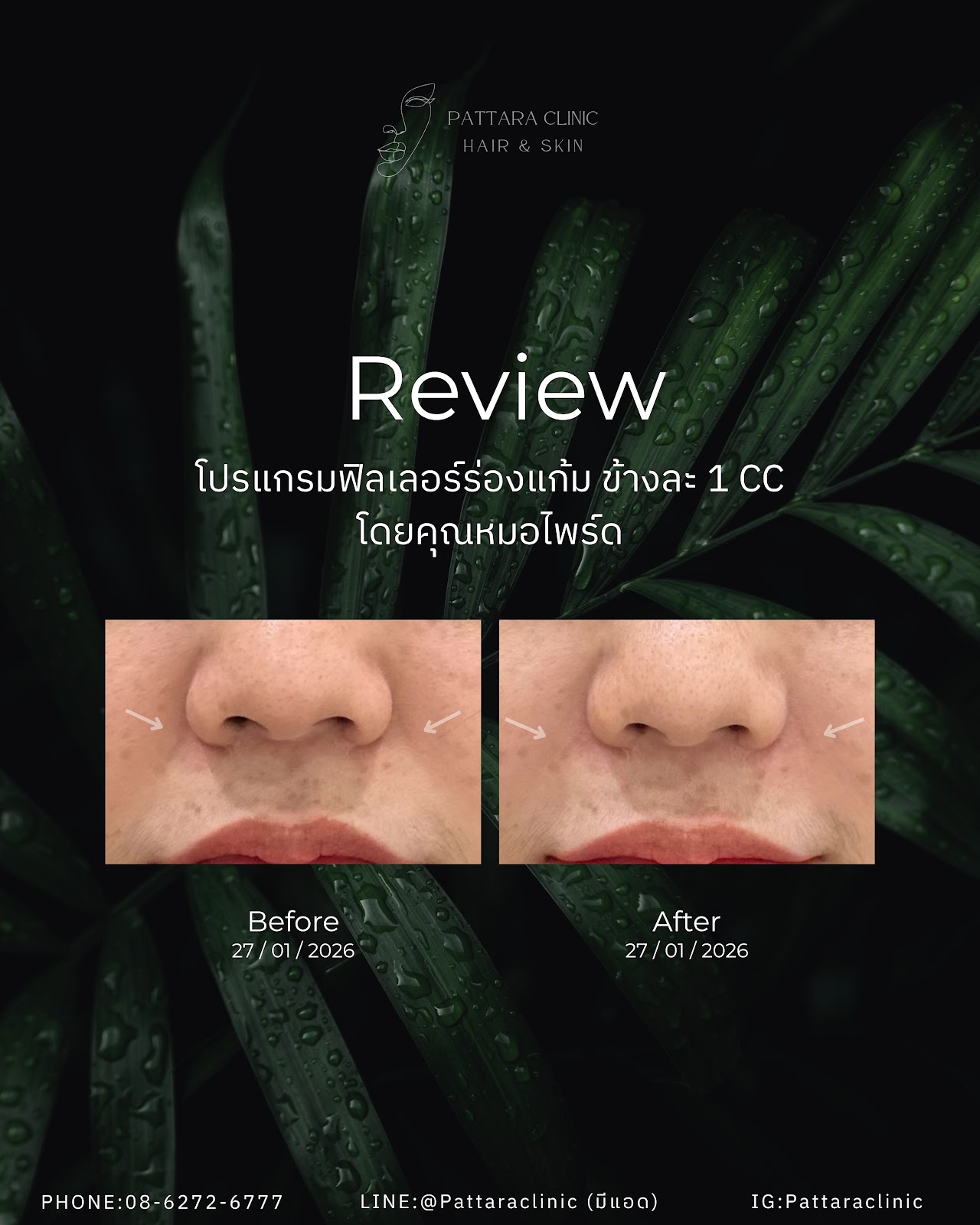 รีวิวฟิลเลอร์ร่องแก้ม เคสที่ 1