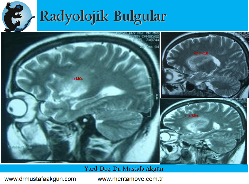 Stroke Hastasının Mentamove ile Rehabilitasyonu