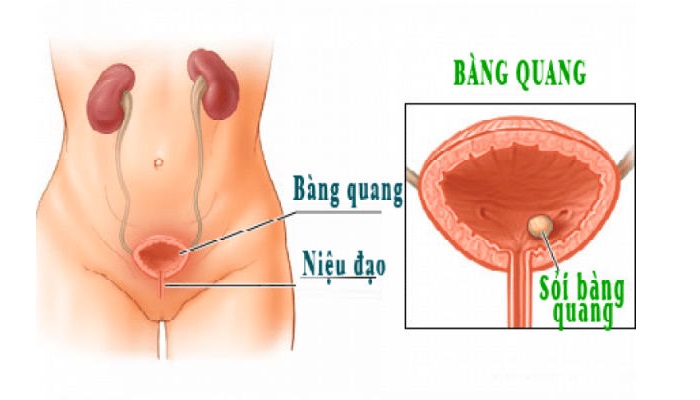 Sỏi thận, sỏi bàng quang là nguyên nhân dẫn đến ứ đọng nước tiểu, gây viêm