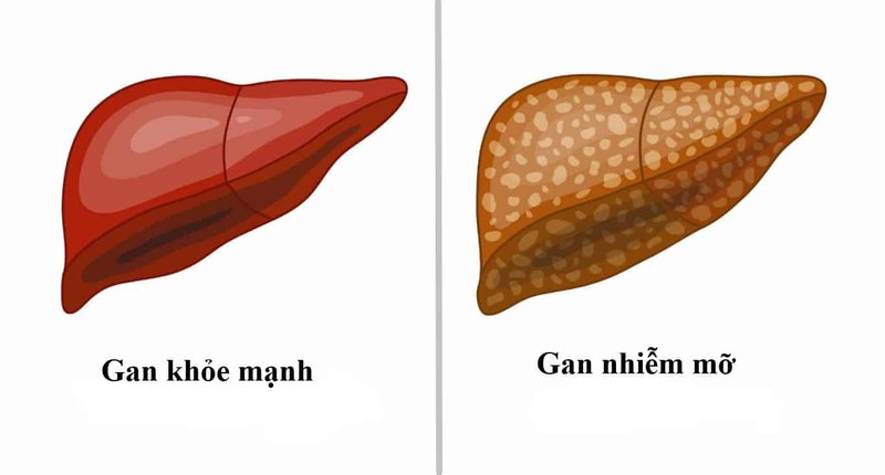 hình ảnh gan nhiễm mỡ
