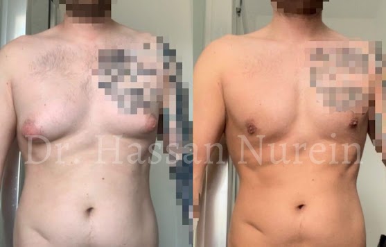 Male Chest Reduction - 001TPC-Side - The Private Clinic of Harley Street  London