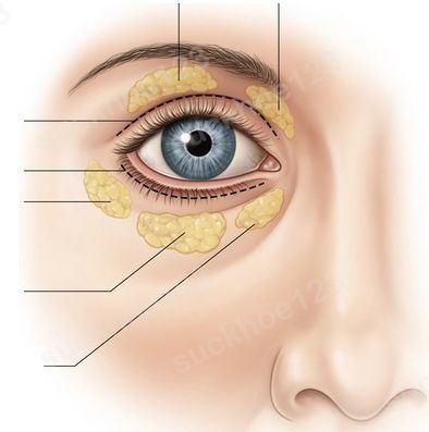 Hút mỡ mí mắt là một trong những phương pháp thẩm mỹ dành cho chị em phụ nữ hiện đại, với mục đích làm cho đôi mắt thêm cuốn hút, hấp dẫn hơn.