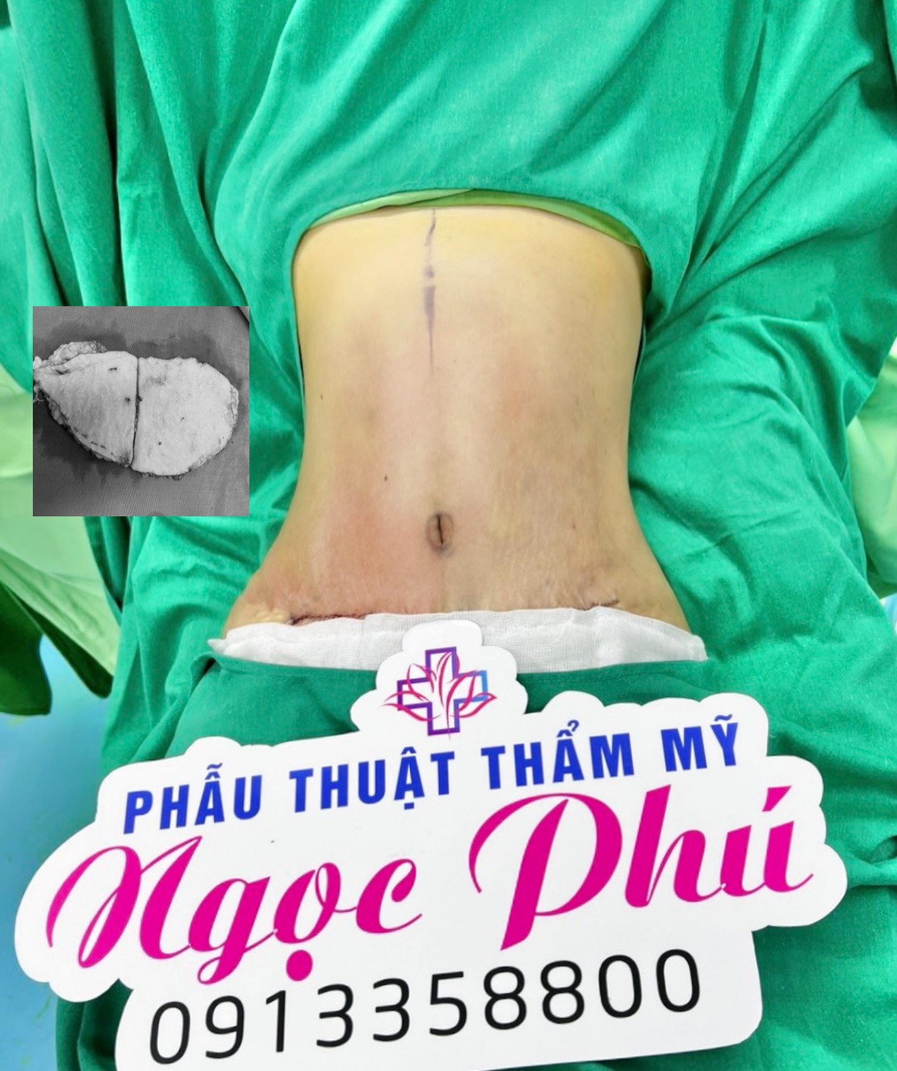 Hút mỡ nội soi là phương pháp hút mỡ bán tự động, sự kết hợp hoàn hảo giữa đầu hút vaser hiện đại cùng công nghệ rung đánh tan các mô mỡ dù là cứng đầu nhất.