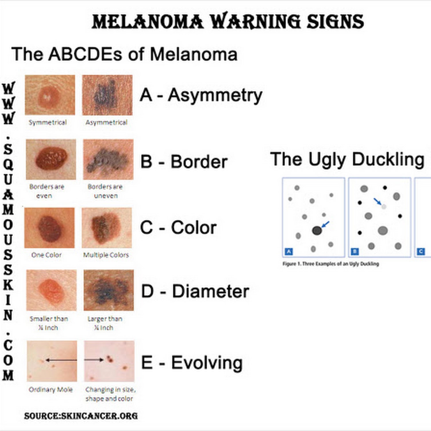 The ABCDEs of spotting melanoma