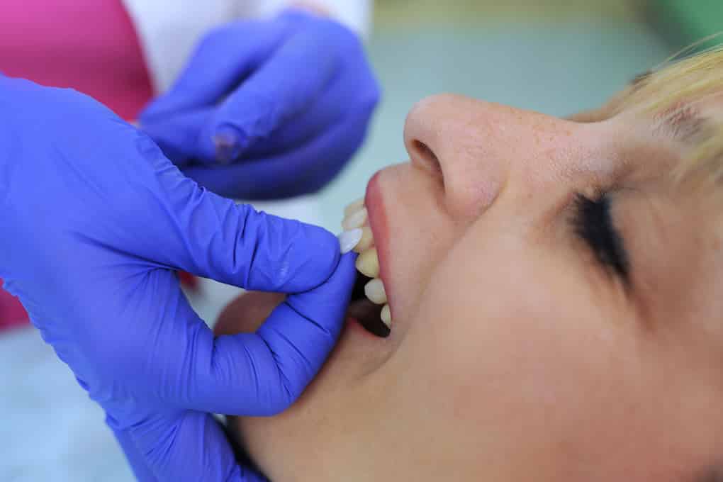 An image of a dentist placing a veneer on a patient's tooth