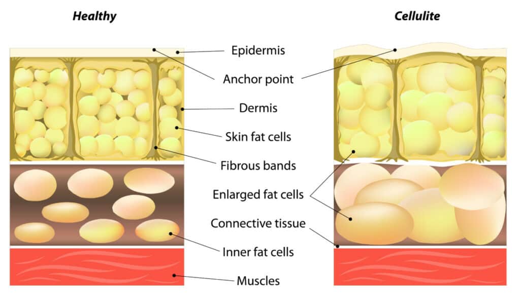 formation of cellulite