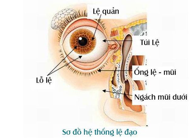 viêm túi lệ là gì