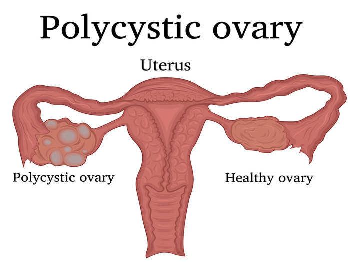 Polycystic ovary