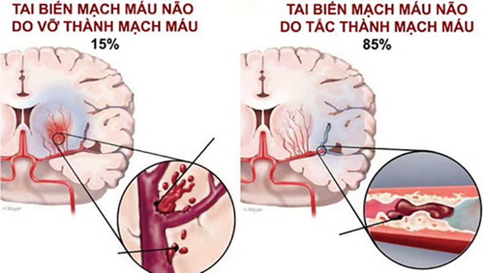 Tai biến mạch máu chia ra làm 2 loại tắc mạch máu não và vỡ mạch máu não. 