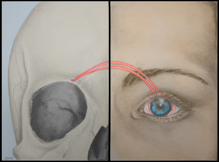 An illustration by the Institute of Advanced Reconstruction shows how a nerve graft is performed during corneal neurotisation.