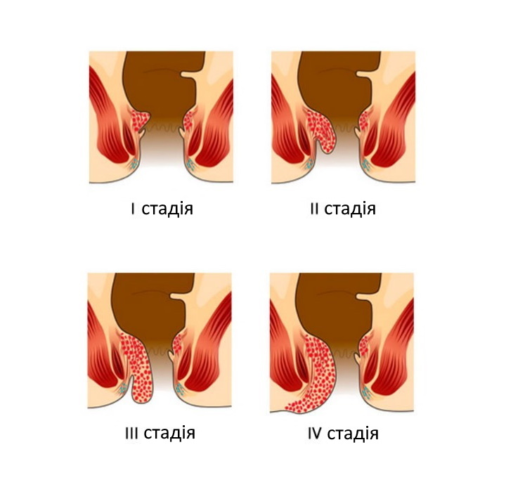 Хронічний геморой розвивається у чотири стадії