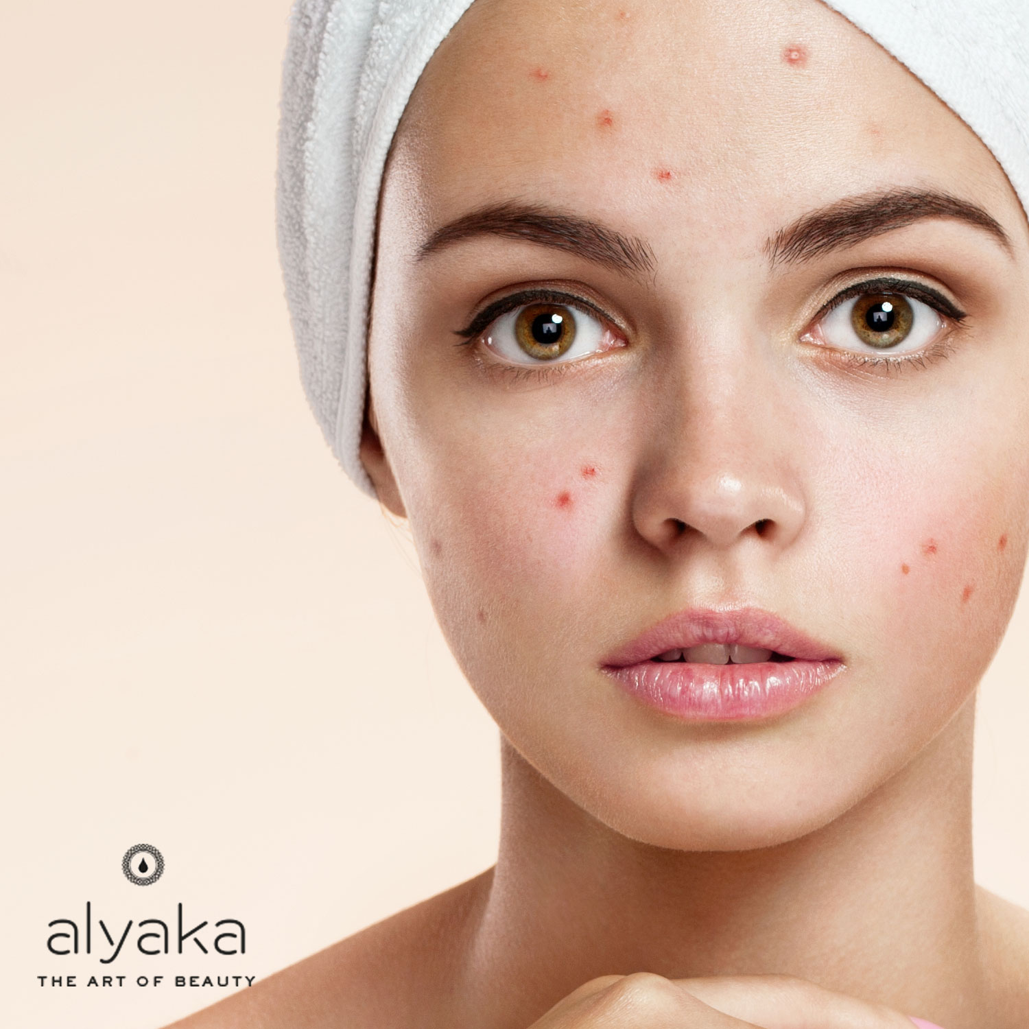 Acne-Prone Skin Type