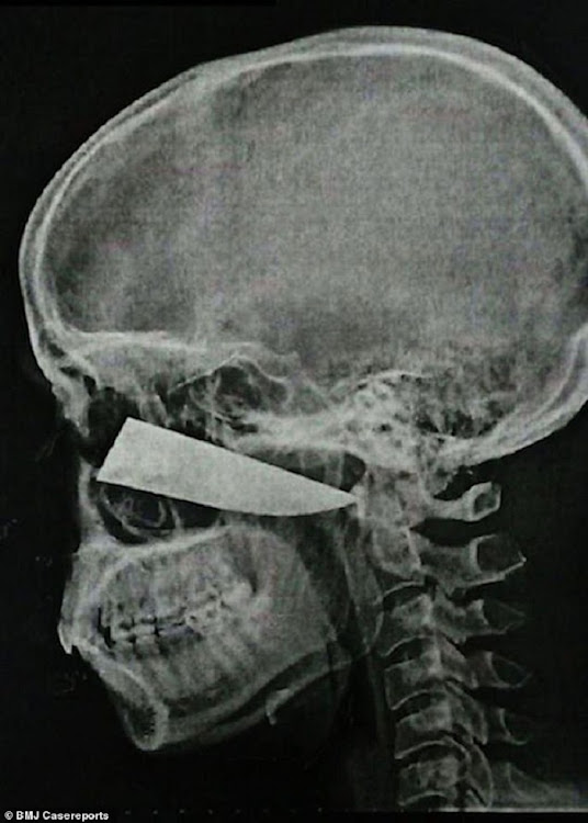 A scan shows the blade embedded in Shaun Wayne's head.