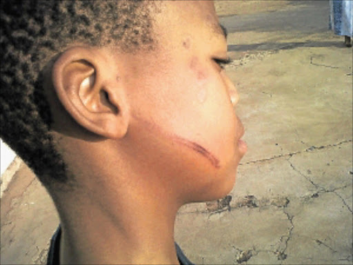 ASSAULTED: The 10-year-old boy who was allegedly hit with an electric cable across the cheek by a teacher at a school in North West.