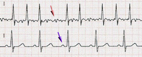 Vorhofflimmern und Sinusrhythmus