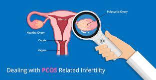 Polycystic Ovarian Disease