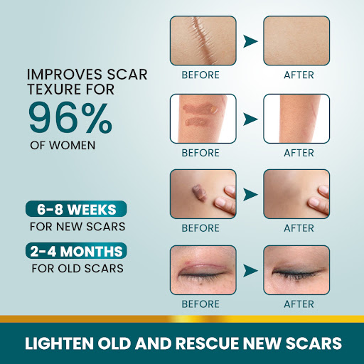 Title 3, Skin Color Scar Patch Skin Surface Smooth 4 x 1...