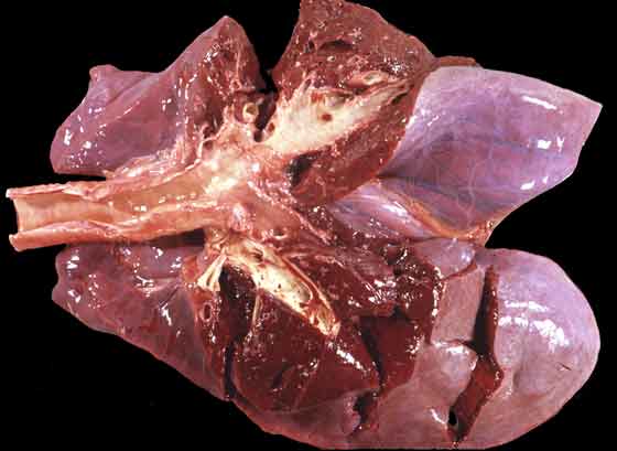 Neonatal pulmonary atelectasis and edema-associated with a large interventricular septal defect of the heart.