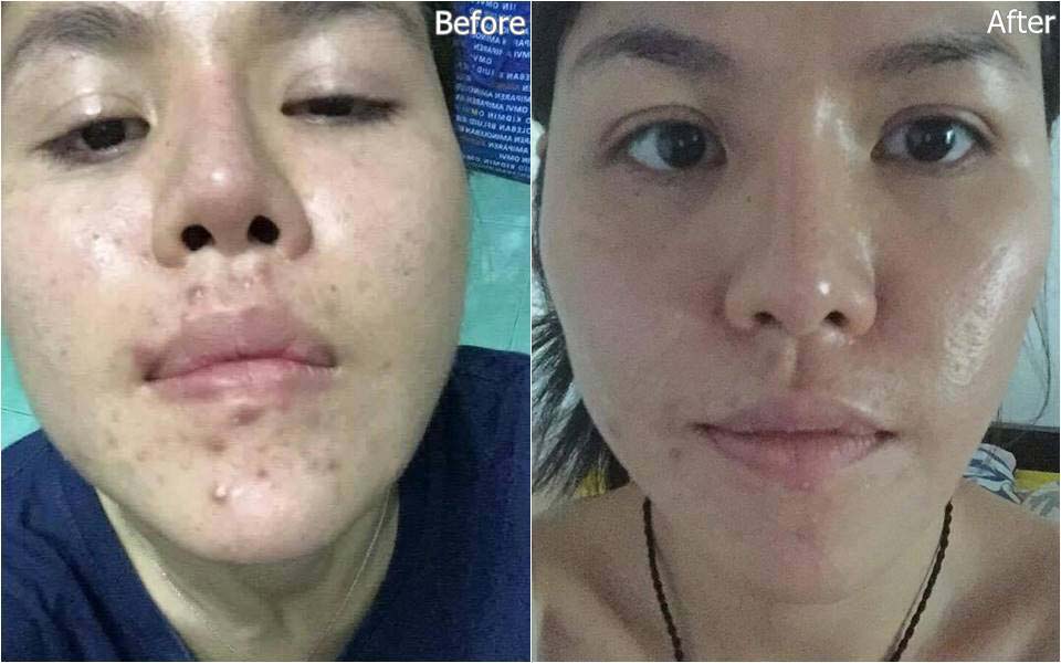 Berof Skincare Acne Treatment Lahore