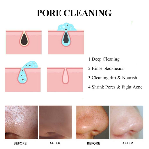 Title 4, Blackhead Cleaning Mud Film Reduces Acne Marks ...