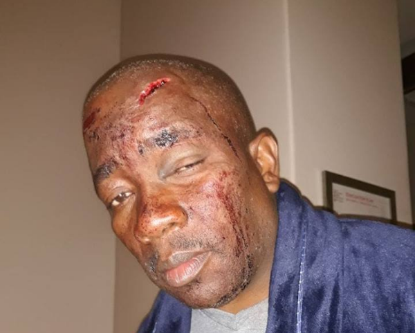 Hartley Sandy Ngoato's injuries after he was attacked at Hartbeespoort Dam in 2018. His attacker is serving a two-year jail term after being convicted of assault and crimen injuria.