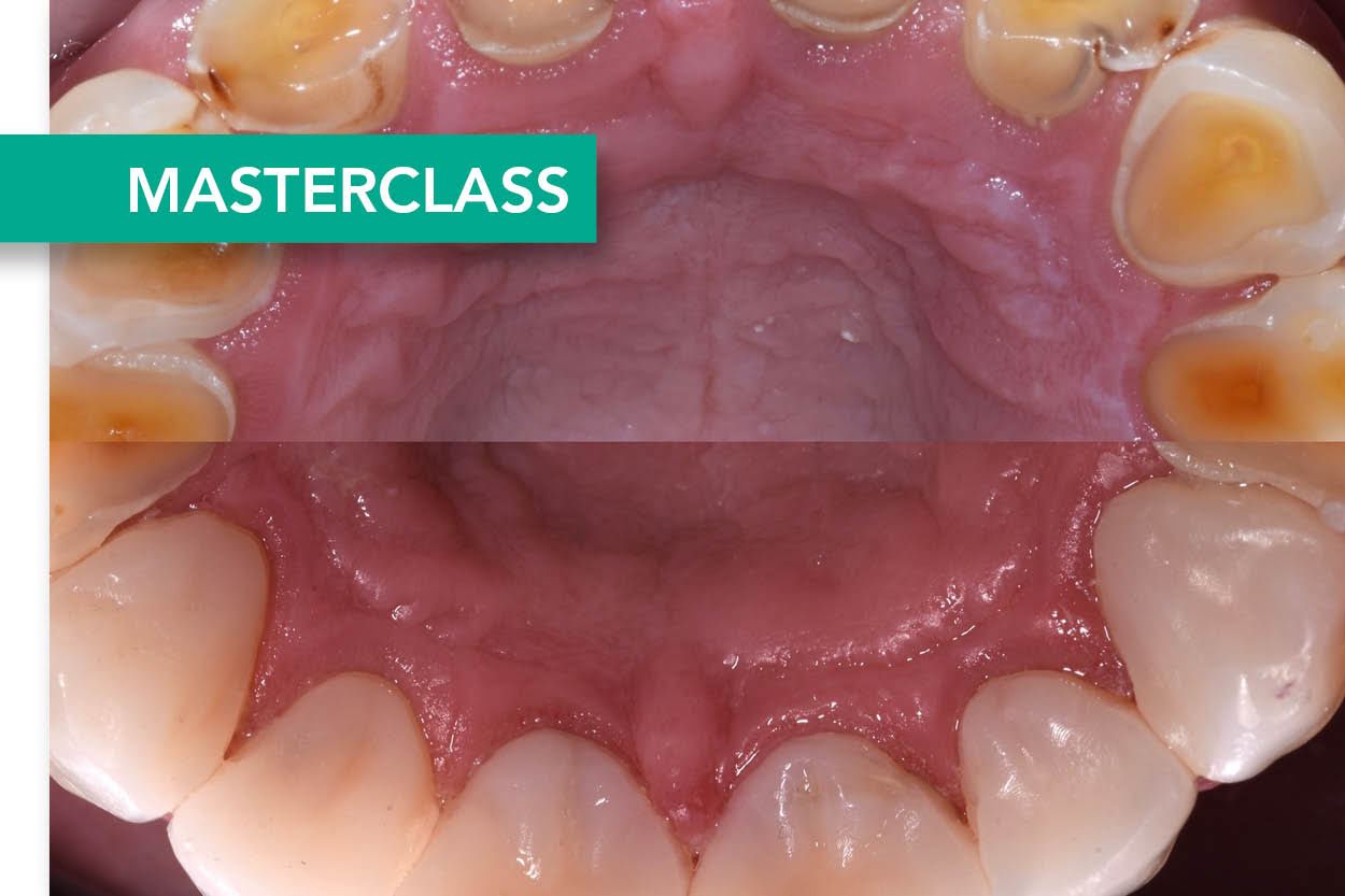 VOLZET! 21 & 22 novembre 2024 - Masterclass: The Tooth wear Course with Dr. Kostas Karagiannopoulos (ENG)