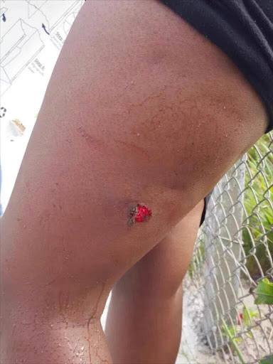 NMMU student shot with rubber bullet in #FessMustFall protest. Twitter