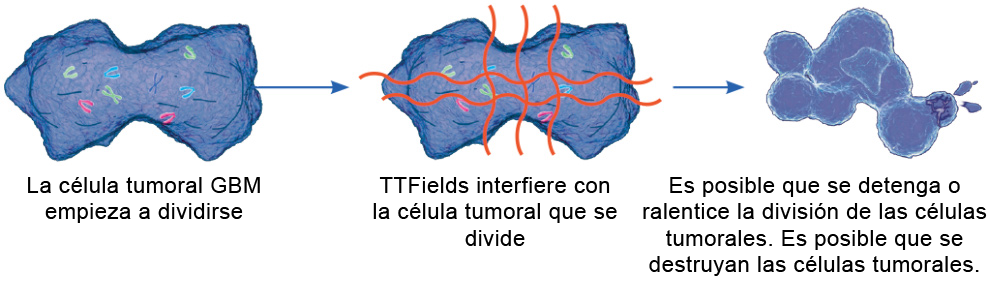 Cómo Optune® trata tumores cerebrales con TTFields