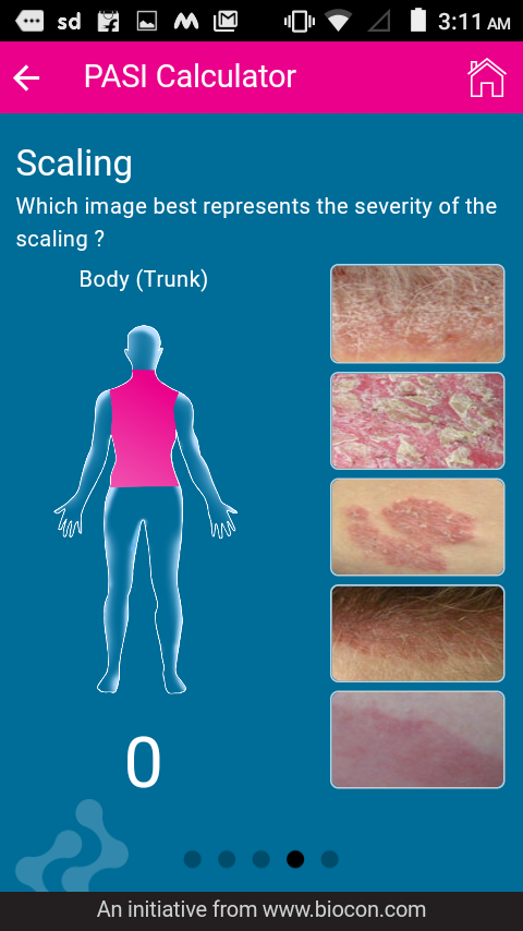 A simplified psoriasis area severity index (SPASI) for ...