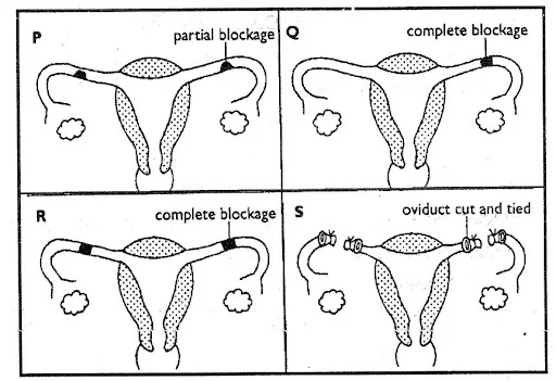 Method of birth control