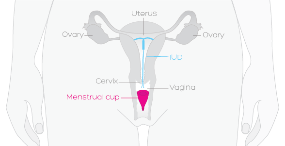 article-usingcupwithIUD_Menstrualcup_diagrams