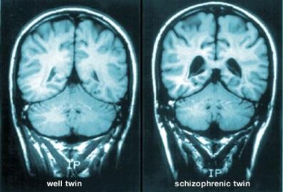 http://img.webmd.com/dtmcms/live/webmd/consumer_assets/site_images/articles/health_tools/schizophrenia_overview_slideshow/webmd_rf_photo_of_mri_brain_scans.jpg