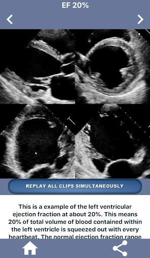 Screenshot HEART EJECTION FRACTION