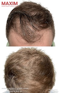 MAXIM Hair Restoration & Transplants in Sarasota, FL, delivers cutting-edge hair regrowth treatment with the expertise of top hair transplant doctors.