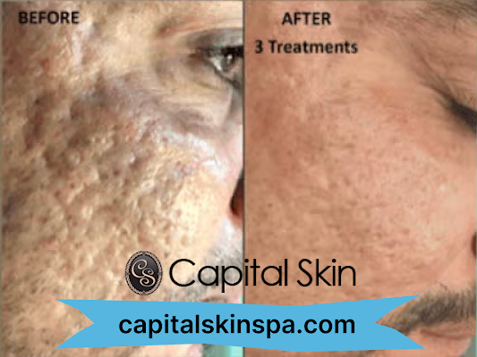 Can't seem to get rid of your acne scars? Capital Skin has the solution for you!